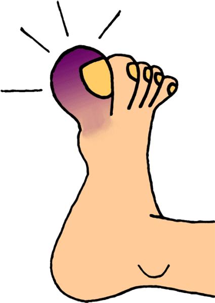 Clipart image of a wounded toe.